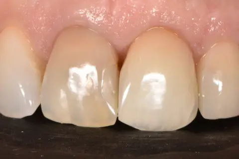Primer plano de dientes frontales, uno de ellos muestra un diente delantero picado con una pequeña cavidad visible.