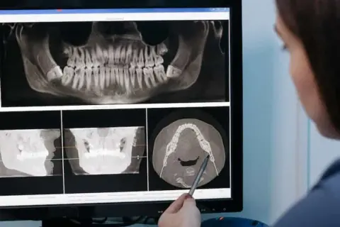 Dentista revisa radiografías dentales, incluyendo una vista panorámica y cortes transversales, para evaluar la necesidad de una elevación de seno maxilar que duele.