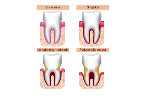 Ilustración muestra la progresión de la enfermedad periodontal, desde encía sana hasta periodontitis severa, con posible pérdida de dientes.