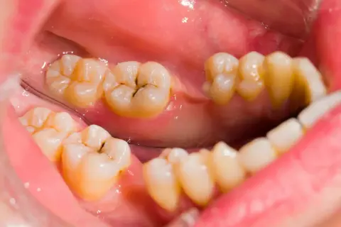 Vista de cerca de dientes con manchas marrones por dentro, mostrando caries y empastes.