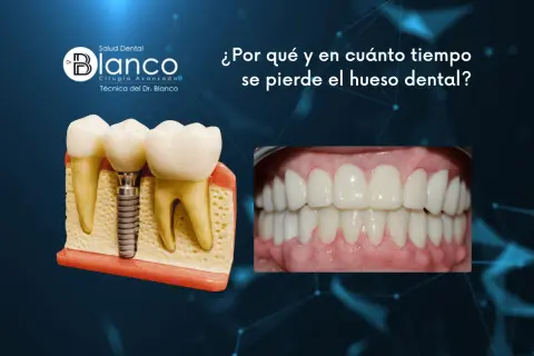 Modelo dental muestra implante y dientes. Foto de sonrisa perfecta. Información sobre cómo recuperar hueso encias.