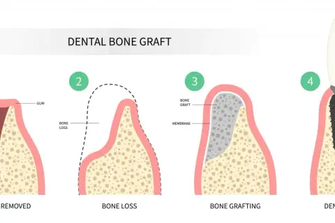 Ilustración del proceso de injerto óseo dental: extracción, pérdida ósea, injerto y colocación de implante para recuperar hueso dental.