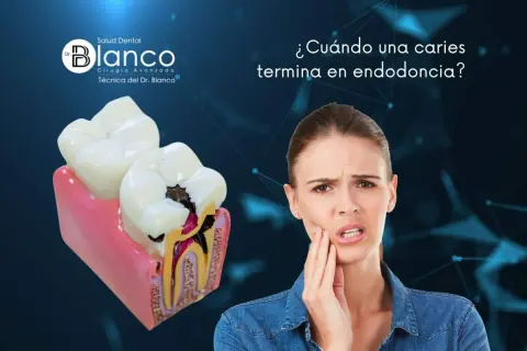 Una mujer con dolor de muelas mira un modelo dental que muestra una caries profunda. ¿Qué pasa si una caries llega al nervio?