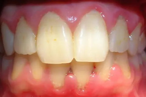 Encías inflamadas y enrojecidas, con signos de gingivitis por estrés. Se observan dientes con manchas y la línea de la encía retraída en algunas zonas.