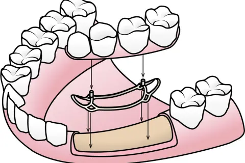Si no tienes hueso para implante dental, una prótesis parcial removible como esta puede ser tu solución.