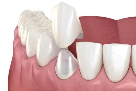 Coronas de disilicato de litio listas para ser colocadas en los dientes, mejorando la estética dental.
