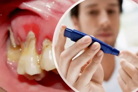 Dientes con caries y encías inflamadas, junto a un hombre midiéndose el azúcar. La diabetes puede empeorar la salud bucal.