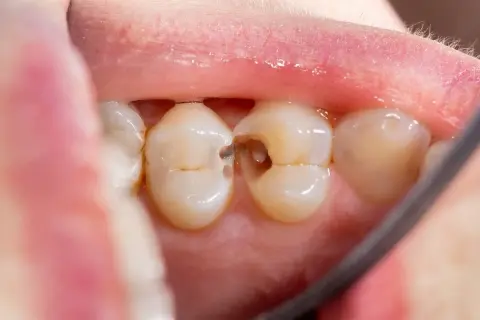 Vista de cerca de una muela con una caries visible. Se aprecian los dientes sanos y la cavidad oscura de la caries.