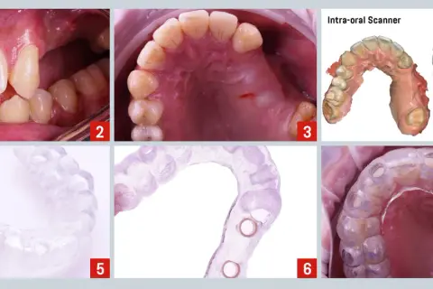 Guía quirúrgica para implantes dentales, planificando un puente dental en los dientes delanteros.