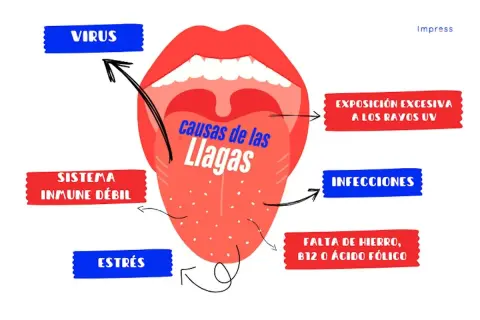 Ilustración de boca abierta mostrando la lengua con puntos, con flechas que señalan las ampollas en la boca causas: virus, sistema inmune débil, estrés, exposición UV, infecciones, falta de hierro/B12/ácido fólico.
