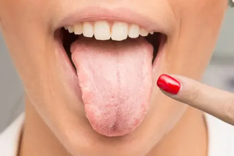 Dedo con uña roja señala lengua con aspecto blanquecino, sugiriendo la necesidad de un enjuague antifúngico.