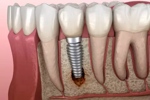 Ilustración de un implante dental con bolsas inflamatorias alrededor, mostrando la pérdida ósea y la irritación de los tejidos.