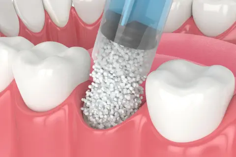 Jeringa aplicando material para poner hueso en la encía, cerca de los dientes.