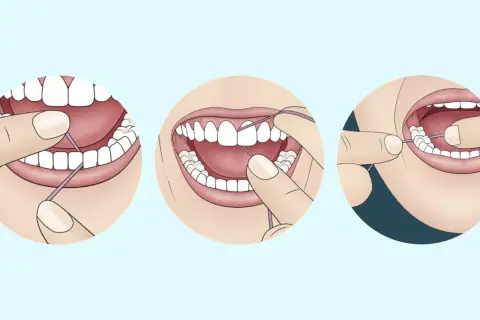 Ilustración muestra cómo usar hilo dental para limpiar entre los dientes. El hilo dental para que sirve es eliminar restos de comida y placa.