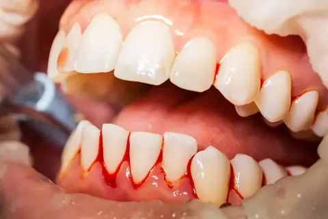 Encías sangrantes alrededor de los dientes, una posible causa de porque sangran las encias de noche.