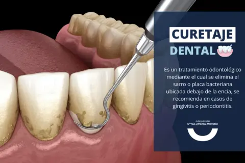 Instrumento dental elimina sarro bajo la encía. El curetaje dental es esencial para tratar la gingivitis y periodontitis.