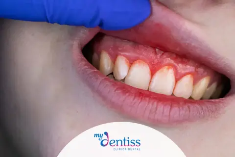 Encías inflamadas y rojas. Aprende como limpiar las encías correctamente para una salud bucal óptima.