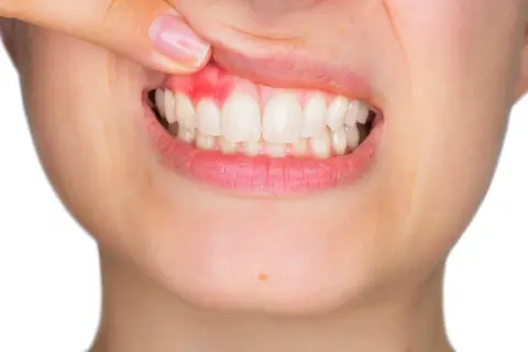 Dedo revela encía gingival inflamada y enrojecida alrededor de dientes blancos.