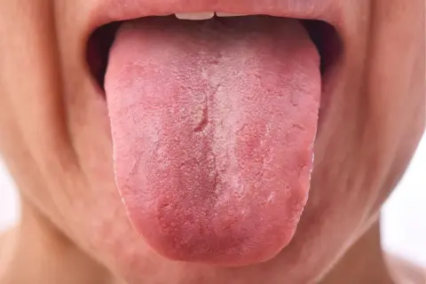 Lengua rosada con una capa blanquecina, posiblemente por uso de clorhexidina.