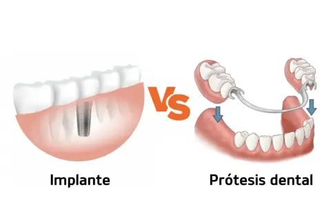 Comparación de implante dental y prótesis para solucionar la falta de dientes.