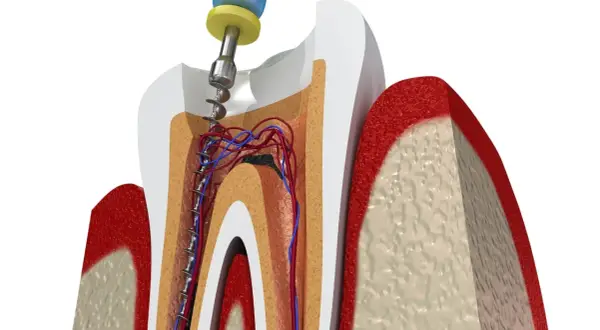 Procedimiento dental para tratar una muela picada, mostrando la limpieza del conducto radicular con una lima.