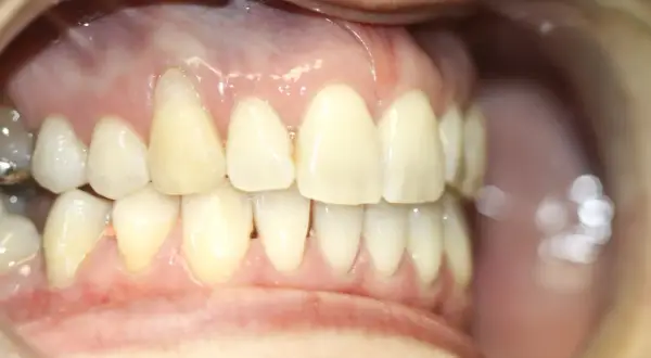 Dientes sanos y encías rosadas, sin signos de poner encías retraídas.