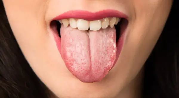 Boca abierta mostrando lengua rosada con pequeñas manchas rojas, reflejo de la ansiedad en la boca.
