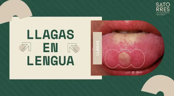 Una llaga con pus en la lengua, destacada en un gráfico que dice "LLAGAS EN LENGUA".