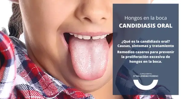Primer plano de una lengua con aspecto blanquecino, indicando candidiasis oral. El texto informa sobre causas, síntomas y tratamiento.