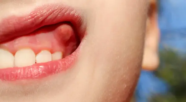 Un pequeño bulto rojizo en la encía, un flemon encia sin dolor, cerca de los dientes frontales.
