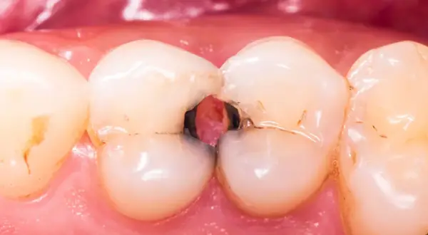 Caries severa en la arcada dental inferior, con cavidades profundas entre los dientes.