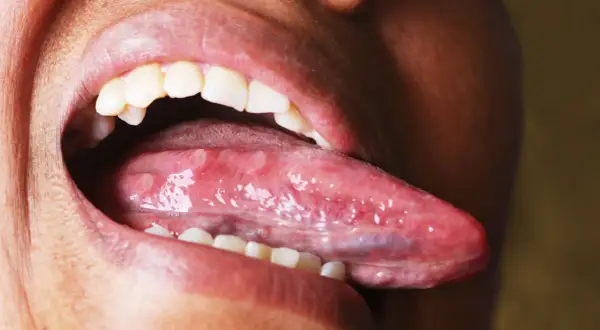 Boca abierta mostrando la lengua con múltiples llagas blancas y rojas, una llaga en la lengua que no se cura.