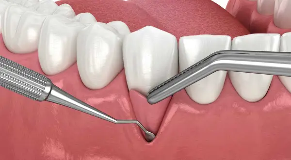Ilustración dental que muestra el inicio de un trasplante de encía, con instrumentos quirúrgicos listos para el procedimiento.