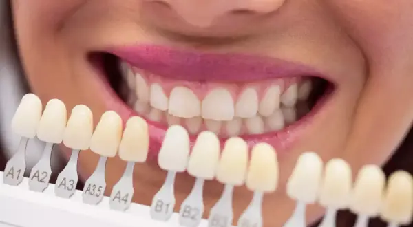 Comparación de tonos para una dentadura de zirconio perfecta.