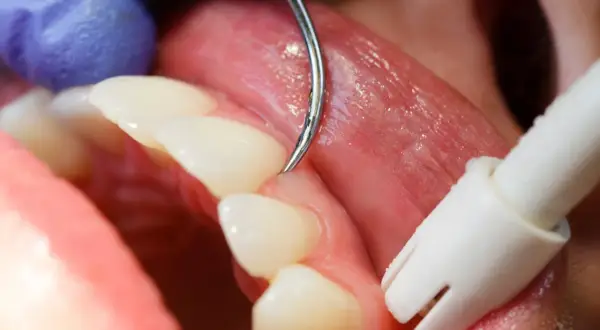 Detalles de un tratamiento dental para como tratar la gingivitis. Un dentista usa un scaler para limpiar los dientes.