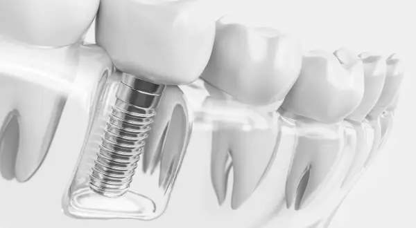 Detalle de implantes dentales tornillos, mostrando su integración en el hueso y la corona dental.