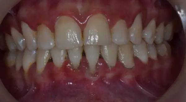 Encías inflamadas y dientes con sarro, signos de periodontitis avanzada, a menudo agravada por el tabaco.