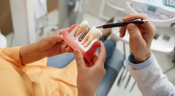 Dentista explica modelo de implante dental. Conoce qué no se puede hacer después de un implante dental para asegurar su éxito.