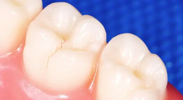 Detalle de una muela con una fisura fina. Aprende como arreglar una fisura en la muela para mantener tu sonrisa sana.