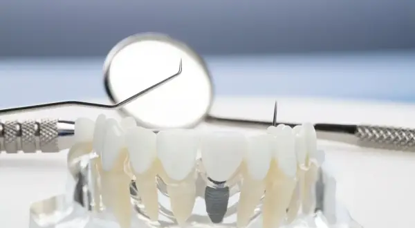 Modelo dental con implantes osteointegrados, mostrando la integración de un implante en la mandíbula, junto a herramientas dentales.