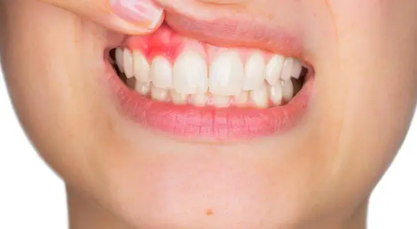 Encía inflamada y enrojecida, mostrando un posible flemón sin dolor. Dientes blancos y sanos.