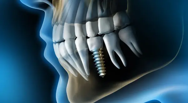 Implante dental en el hueso maxilofacial, mostrando la estructura ósea y los dientes.
