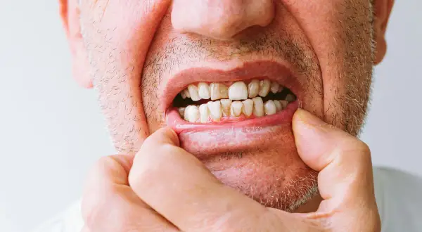 Primer plano de la boca de un hombre, mostrando un diente roto y otros dientes desgastados.