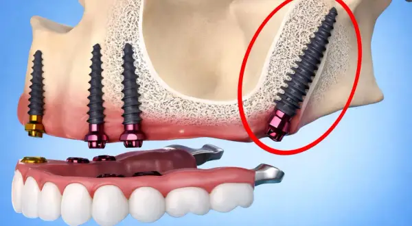 Implantes dentales en el hueso maxilar, uno de ellos en el área del hueso pterigoides, con una prótesis dental.
