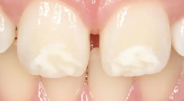 Manchas blancas en las muelas, que no son caries, se ven en los dientes frontales.