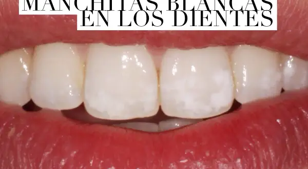 Primer plano de una boca mostrando dientes con manchas blancas.