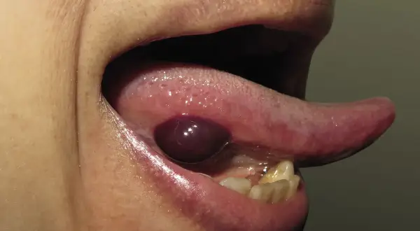 Ampolla oscura y abultada debajo de la lengua, con la lengua extendida.