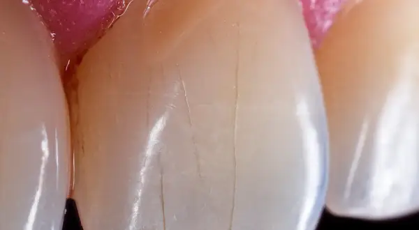 Detalle de dientes con finas líneas verticales que sugieren una infracción del esmalte.
