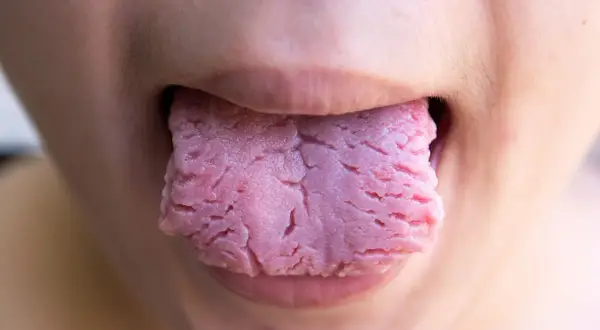 Lengua rosada con surcos profundos y aspecto rugoso, similar a llagas rojas en la lengua, asomando entre los labios.