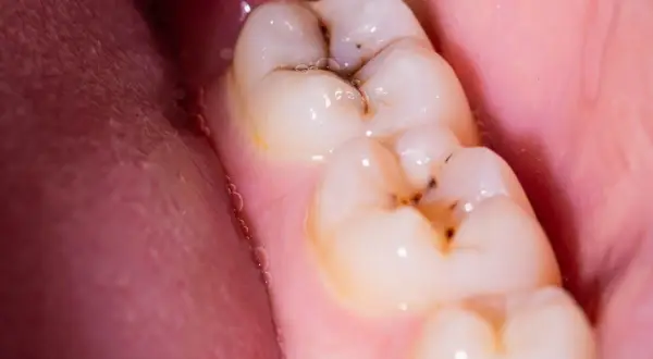 Muelas con caries y empastes. Se observa una muela picada con restos de comida y un empaste dental.